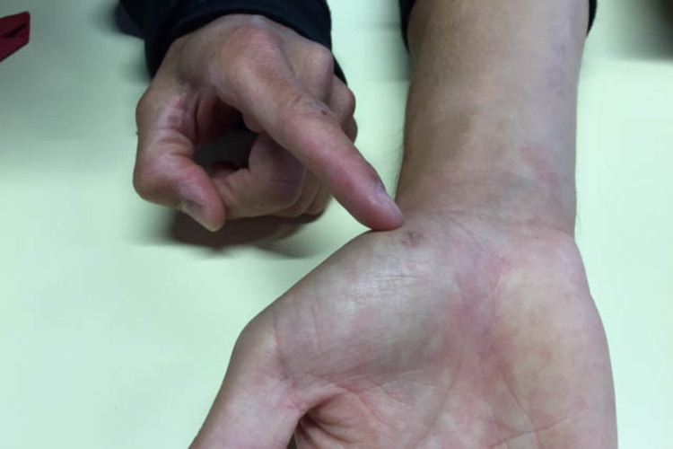 Der Zeigefinger von Sandro Cortese zeigt auf die OP-Wunde von Stefan Bradl