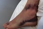 Diesen Fuss quetschte Alex Lowes in einen Rennstiefel