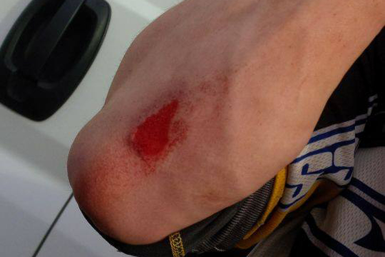 Beim Moto Cross Training bleibt gelegentlich ein Stück Haut auf der Strecke
