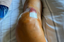 Das frisch operierte Knie von Franz Zorn