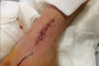 Die Operation an James Toselands rechter Hand verlief problemlos