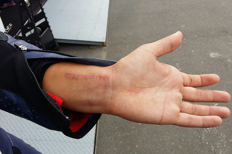 So sieht Maria Herreras verletzter Arm aktuell aus