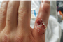 Gines' Finger vorher