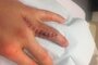 Die Hand ist nach dem Eingriff dick angeschwollen