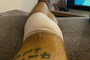 Das linke Knie von Kenneth Kruse Hansen nach der OP