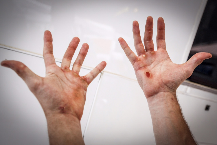 Diese Hände sind ein Zeugnis der Anstrengungen und der Opfer, die ein MotoGP-Pilot bringen muss
