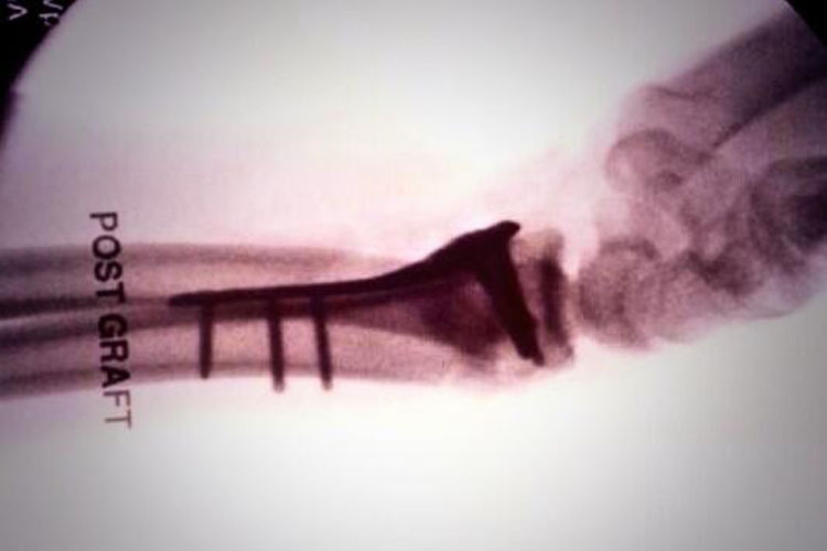 Twitter-Bild von Scott Redding: Sein operiertes, linkes Handgelenk