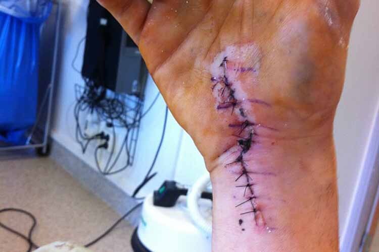 Die rechte Hand von Alex Lundh - zwei Wochen nach der OP