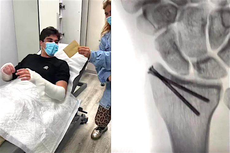 Lance Stroll erzählt von seinen Handverletzungen