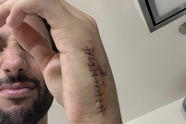 Daniel Ricciardo zeigt seine OP-Narbe an der linken Hand
