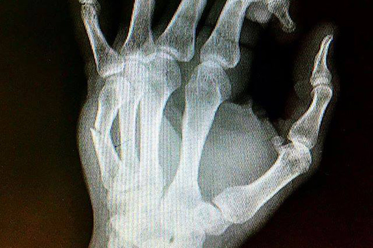 So sah Anthony Wests Hand vor der Operation aus