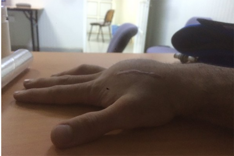 So sah die stark angeschwollene Hand von Danilo Petrucci vor der Operation aus
