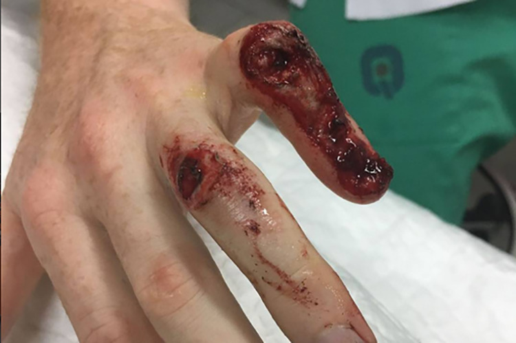 So sah Smiths Finger nach seinem Crash am Samstag aus