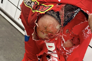 Die Brandwunden von Antonio Cairoli nach seinem Crash in Spring Creek)