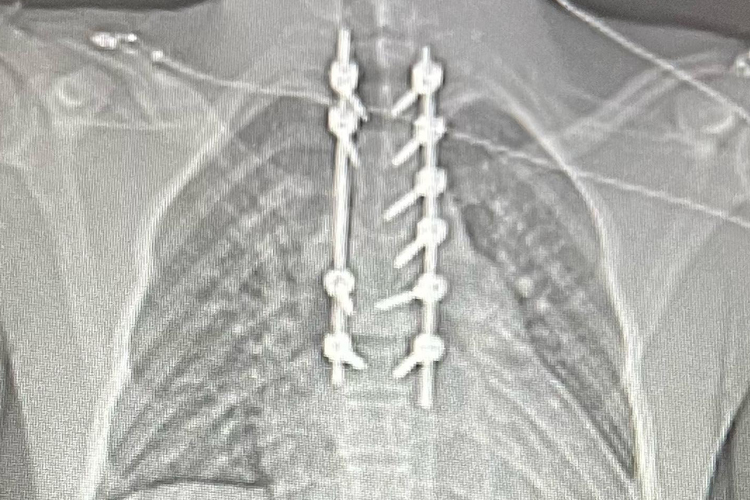 Die Röntgenaufnahme nach der OP zeigt die Metallstangen und Verschraubungen der Wirbelsäule