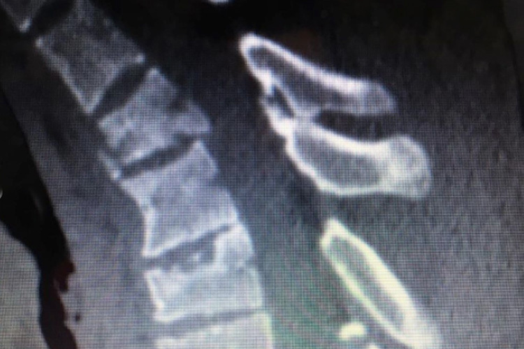 Das Röntgenbild seiner Wirbelsäule zeigt mehrere geschädigte und verschobene Wirbelkörper