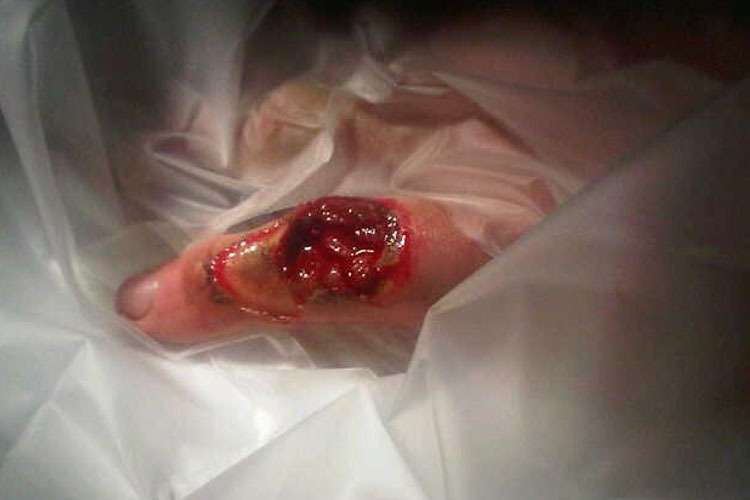 Loch Im Finger Loch Im Finger