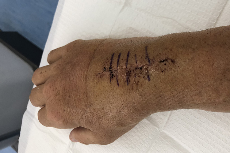 James Toselands rechte Hand hat bereits vier Operationen hinter sich