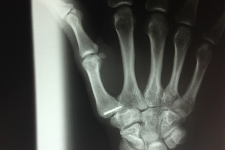 Das Röntgenbild macht die Brüche in der Hand sichtbar