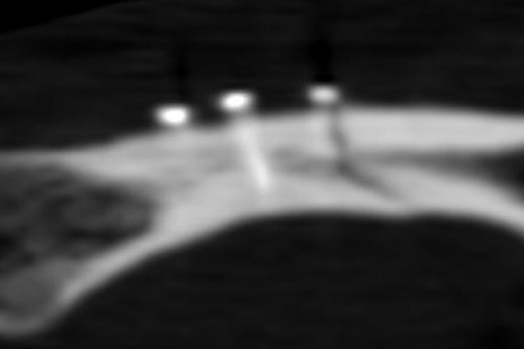 Der Riss im Knochen ist im Röntgenbild erkennbar