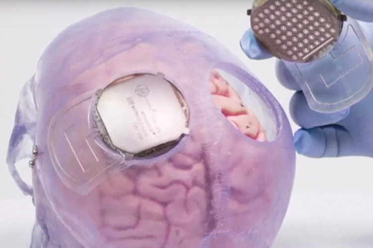 Kabellose Elektroden werden auf die harte Hirnhaut des Patienten implantiert, um die Steuerung der Beine selbstbestimmt vornehmen zu können