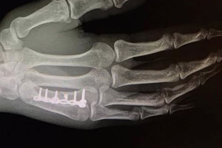 Die Röntgenaufnahme des gebrochenen Mittelhandknochens von Jeffrey Herlings