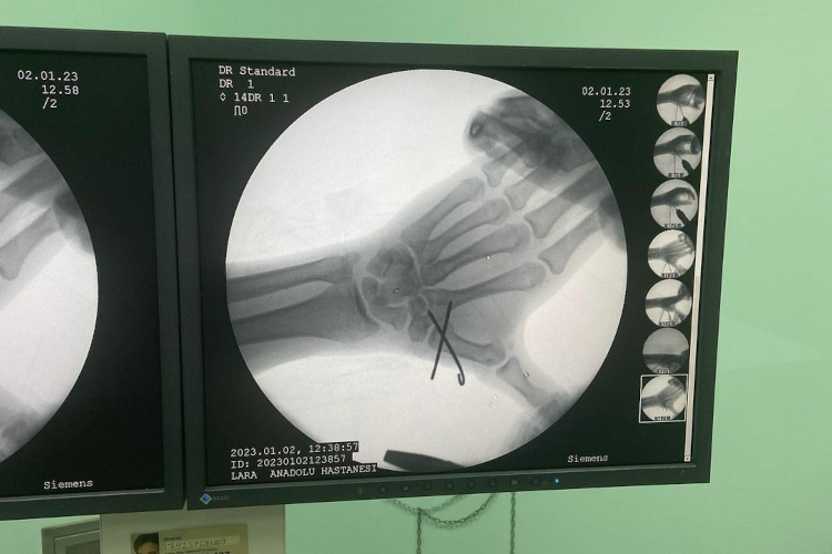 Die rechte Hand von Deniz Öncü: Der Bruch wurde operativ fixiert