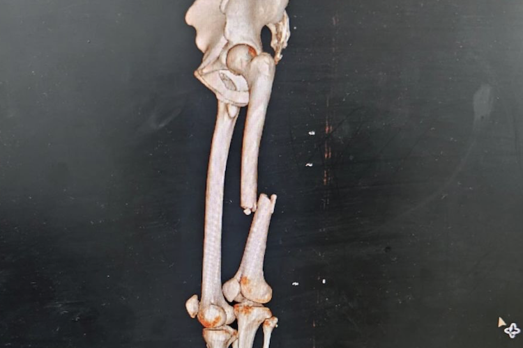 So sah sein Oberschenkelknochen vor der Operation aus