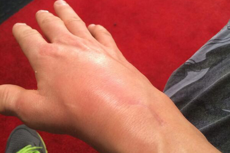 So geschwollen war Haydens Handgelenk nach den Rennen