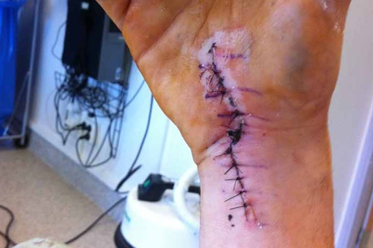 Alexander Lundhs rechte Hand nach der ersten Operation