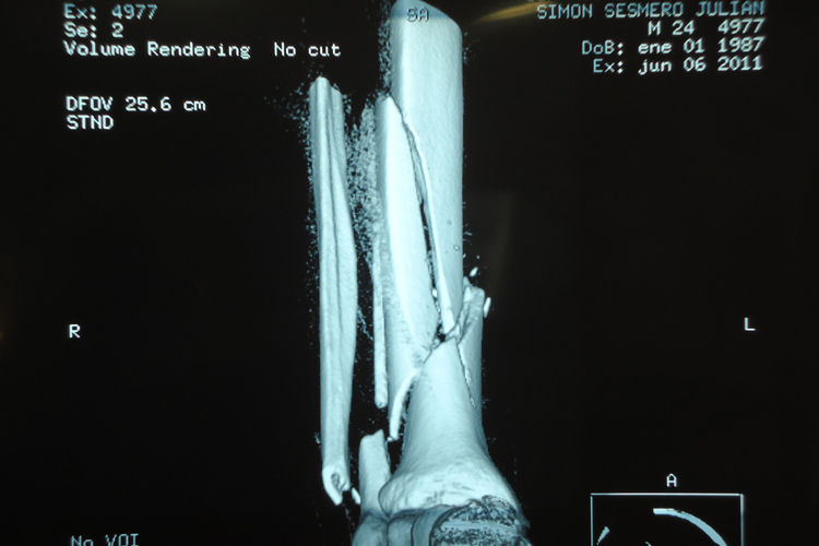Röntgenaufnahme von Simóns Bein vor der OP