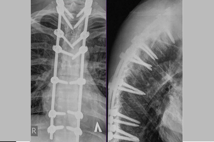 Das Röntgenbild von Tonkovs verletzter Wirbelsäule