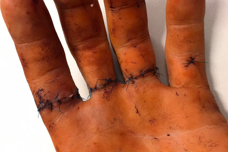 Nach der Operation sind Luca Schmidts Finger gerettet