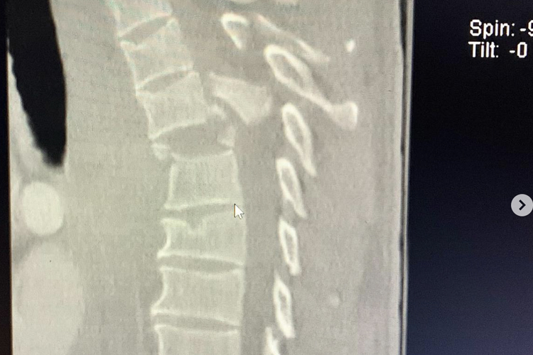 Die Röntgenaufnahme zeigt das Ausmaß der Rückenverletzung