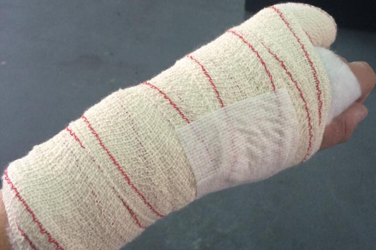 Finger Angebrochen Finger Angebrochen