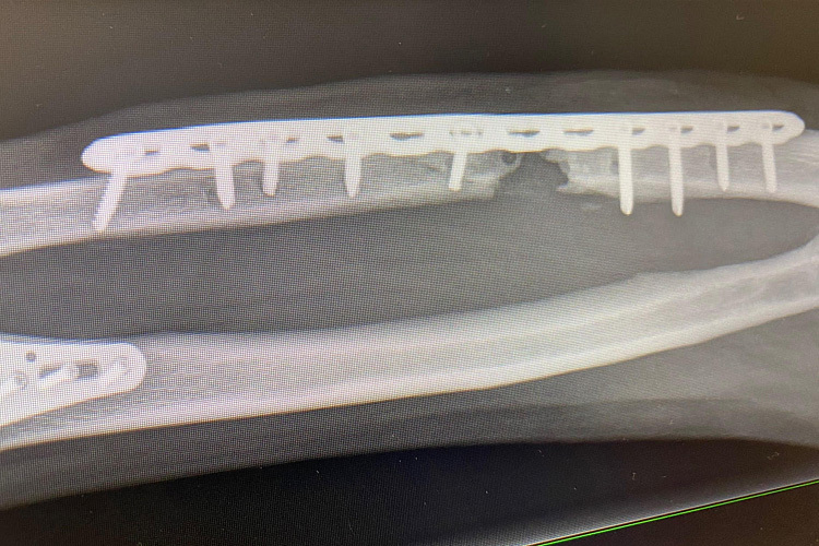 Auf dem Röntgenbild ist die Fehlstelle im Unterarmknochen deutlich zu sehen