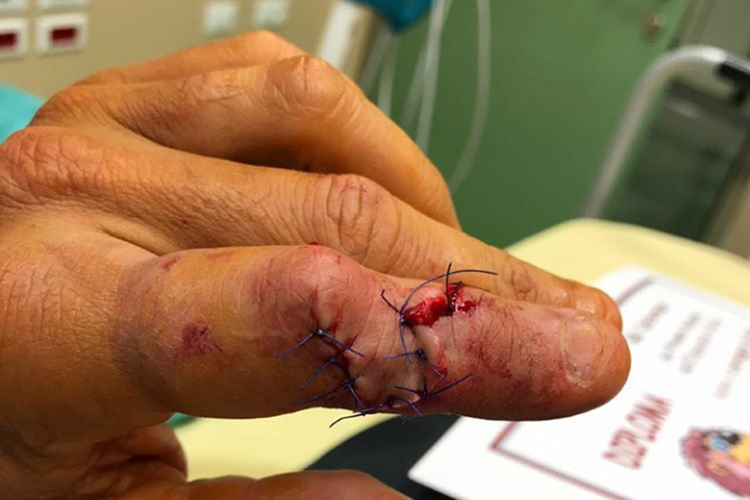 So sah Crutchlows Finger nach der OP aus
