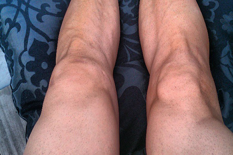 Instagram-Bild von Cairoli: Das linke Knie ist zwei Tage nach dem Sturz geschwollen