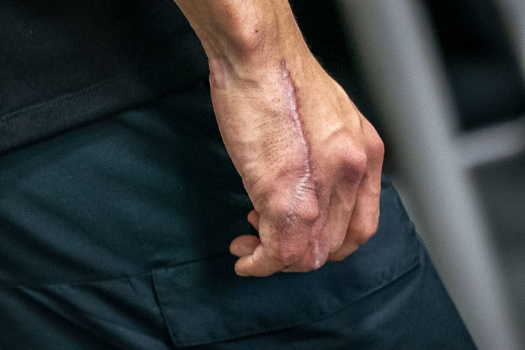 Les cicatrices sur la main de Taka sont clairement visibles