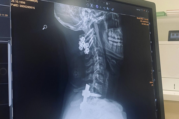 Das Röntgenbild der Wirbelsäule nach der OP